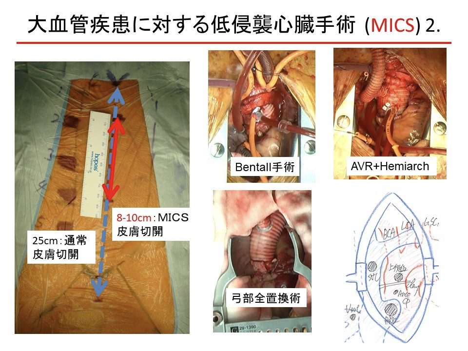 大血管疾患に対する低侵襲心臓手術（MICS）2