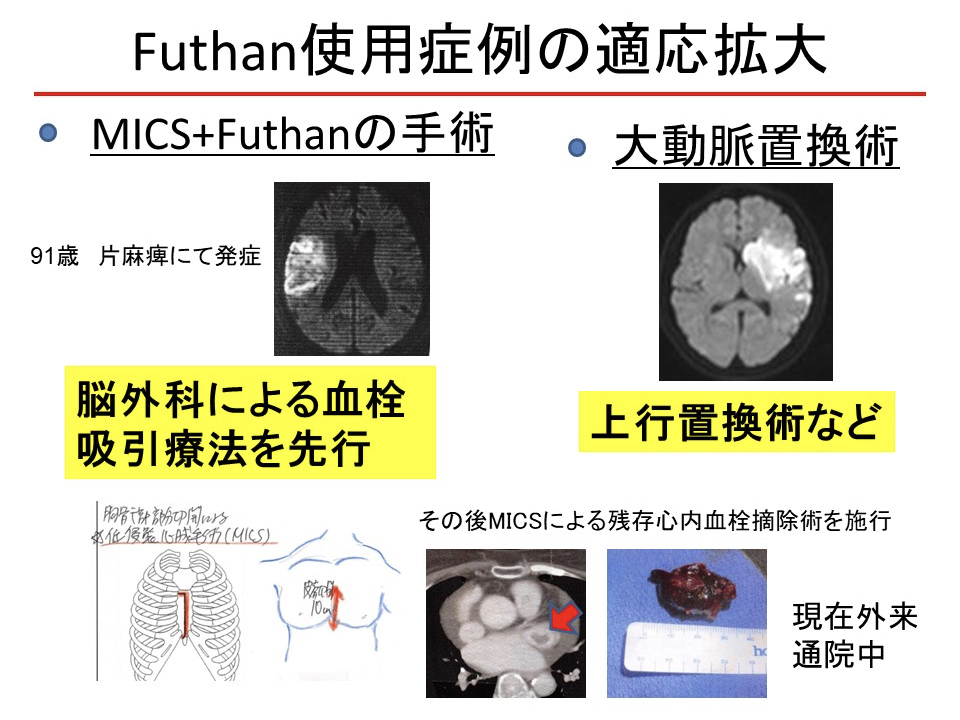 Futhan使用症例の適応拡大
