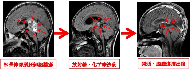 松果体部脳胚細胞腫瘍