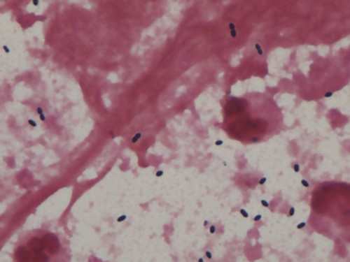 肺炎球菌のグラム染色像